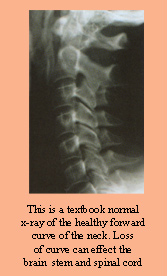 This Is A Textbook Normal X-ray Of The Healthy Forward Curve Of The Neck. Loss Of Curve Can Effect The Brain Stem And Spinal Cord.